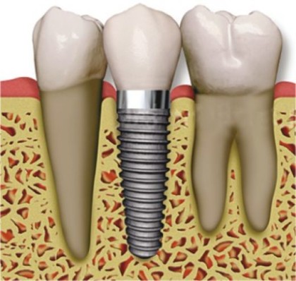 Dental Implants and Costs item-thumbnail